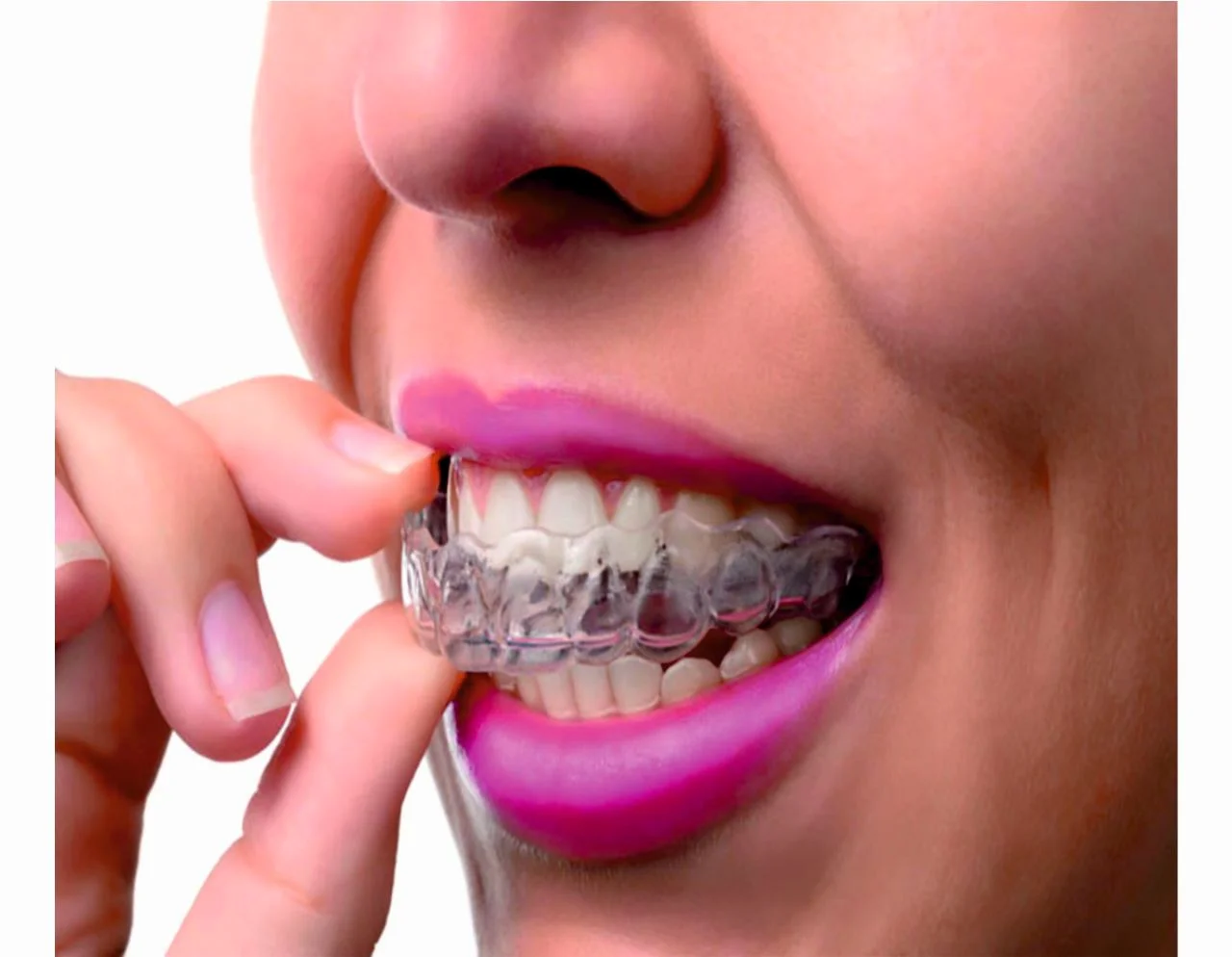 Choosing Between Traditional Braces and Invisalign